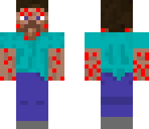 steve with chiken pox