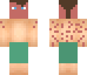 sunburned man