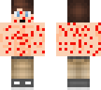 chicken pox