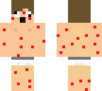 chiken pox derp