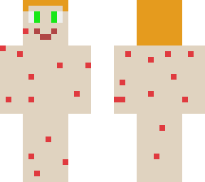 biondino with chickenpox