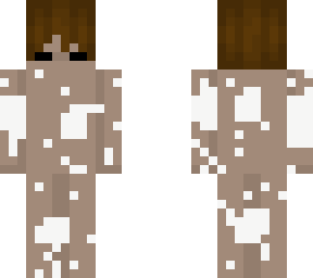 -vitiligo-