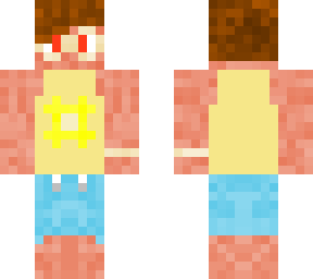 sunburns